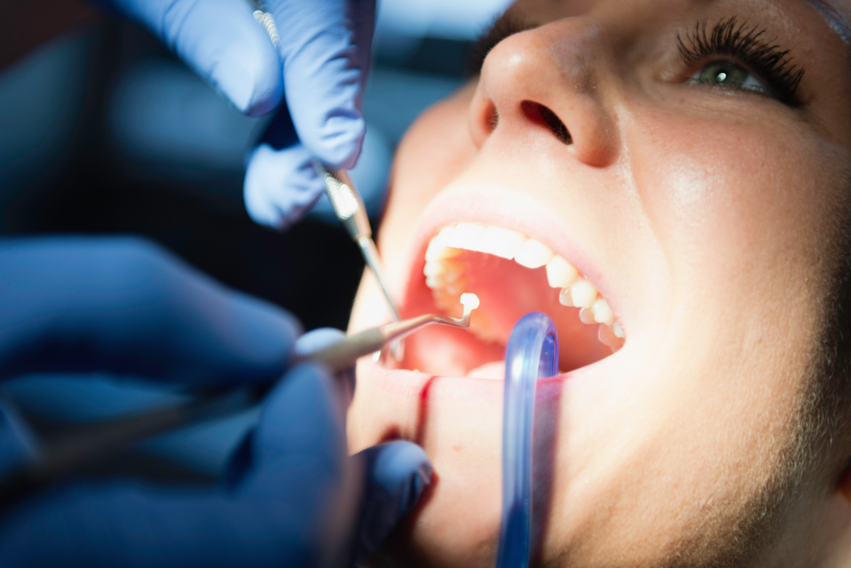 inlay-onlay-dental-fillings-3