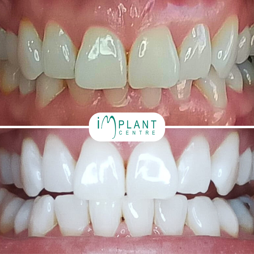 blanchiment dentaire Genève, blanchiment dentaire Suisse, blanchiment dents prix, blanchiment dents professionnel, blanchiment dentaire clinique, blanchiment dentaire tarif, blanchiment dentaire résultat, blanchiment dentaire avant après, blanchiment dents sensibles, traitement blanchiment dentaire, séance blanchiment dentaire, clinique dentaire Genève blanchiment, prix blanchiment dents Genève, meilleur blanchiment dentaire Genève, blanchiment dentaire rapide, blanchiment dentaire efficace, blanchiment dentaire sans douleur, blanchiment dentaire sûr, blanchiment dentaire cosmétique, sourire blanc Genève.